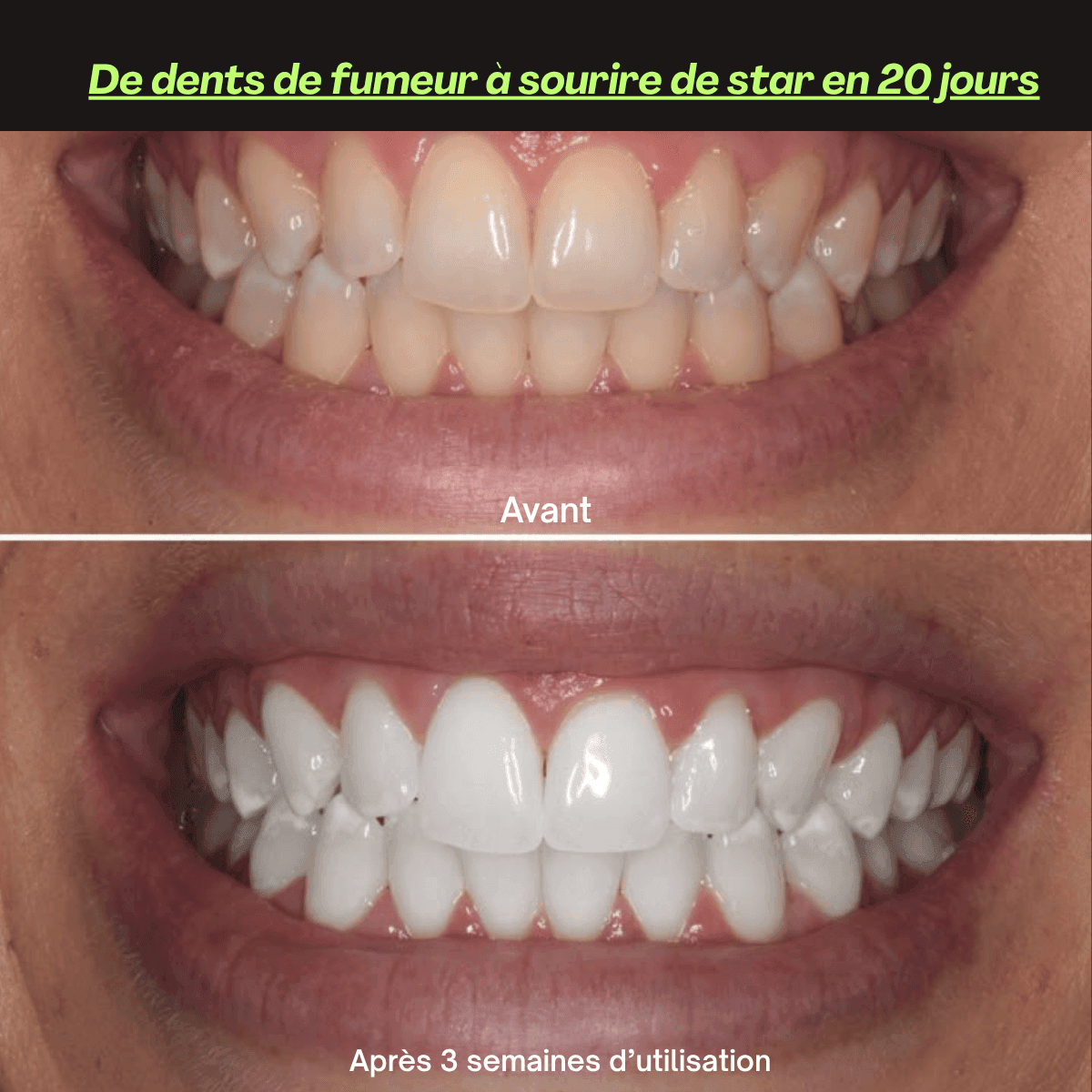 Before and after teeth whitening results by The Formula Bio Labs stained smoker teeth transformed to a brighter smile after 3 weeks